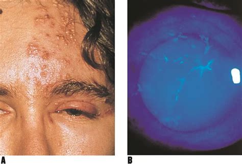 hermes zoster e ulcera alla cornea|herpes zoster ophthalmicus treatment.